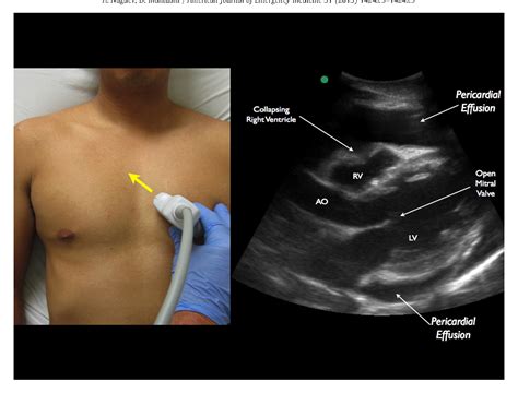 Figure 1 From A Novel In Plane Technique For Ultrasound Guided