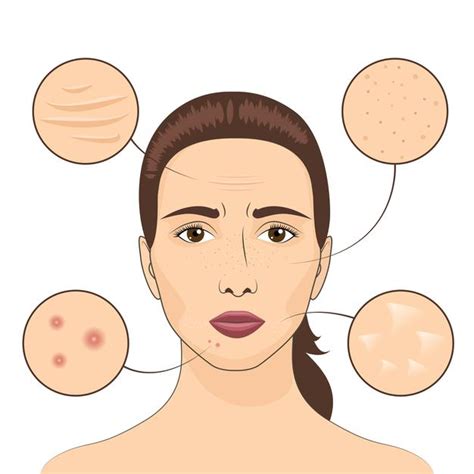 How To Get Rid Of Acne Scars According To Dermatologists My Generic