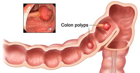 Does Colon Cancer Show In Blood Tests Cancerwalls