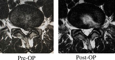 MRI before and after outside-in TELD for a case of L5/S HNP. Note that... | Download Scientific ...