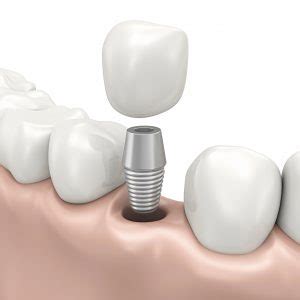 Same Day Dental Implants Implant Dentist Smiling