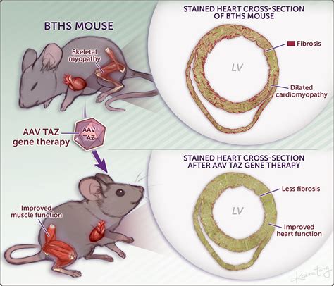 Aav Gene Therapy Prevents And Reverses Heart Failure In A Murine