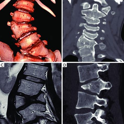 Ao Spine Thoracolumbar Fracture Classification Score A A0