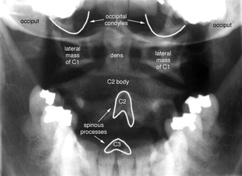 Medical imaging technology: Cervical Spine - Open Mouth (Dens) View anatomy