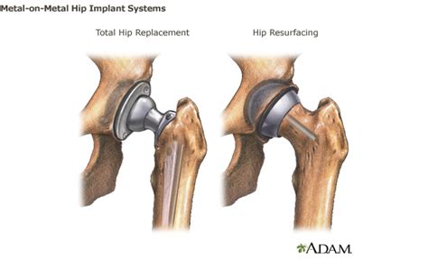 What The Fda Has To Say About Metal On Metal Hips Earls View