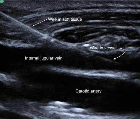 Ultrasound Guided Venous Access Cdem Curriculum