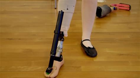 Amputee Ballet Dancer Appeals For En Pointe Prosthetic Foot