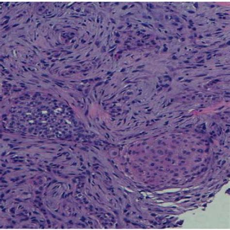 Pdf Metaplastic Breast Carcinoma “fibromatosis Like” Associated With Intraductal Papilloma