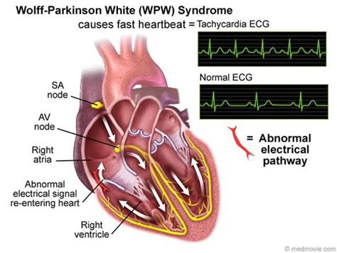 Wolff Parkinson White Syndrome MEDizzy