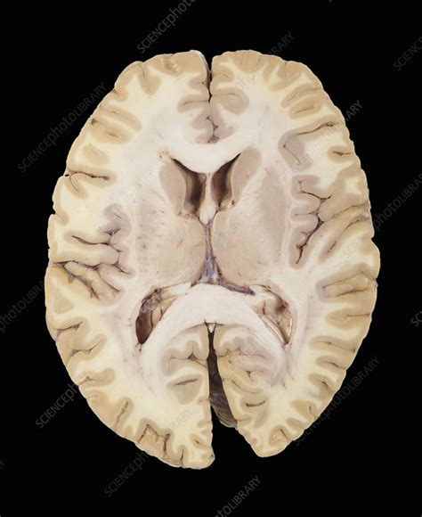 Transverse Section Of The Human Brain Stock Image C0055982