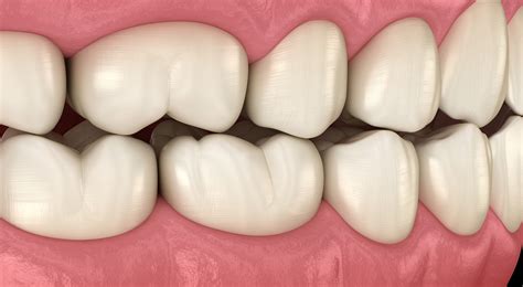 Occlusal (Bite) Adjustment in Sacramento | Drs. Szymanowski