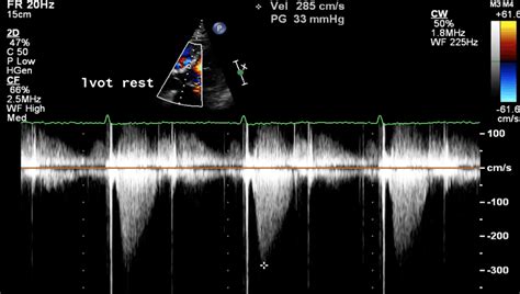 Hypertrophic Cardiomyopathy Cardio Guide