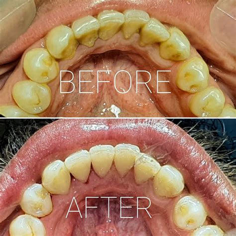 Scaling And Polishing Durranis Dental Clinic Dental Cleaning