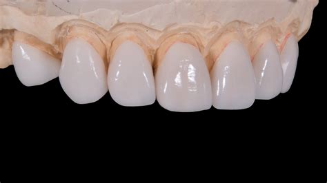 Different Types of Dental Crowns