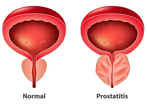 Przerost Prostaty Jakie S Objawy I Metody Leczenia Przerostu Prostaty