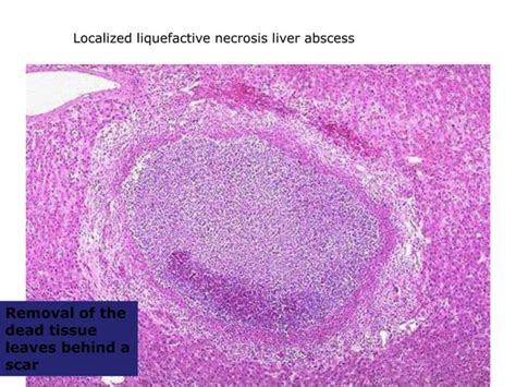 ACUTE INFLAMMATION Pptx