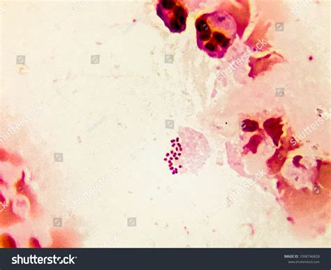 Neisseria Gonorrhoeae Gramstain Gonococcal Urethritis Stock Photo Edit