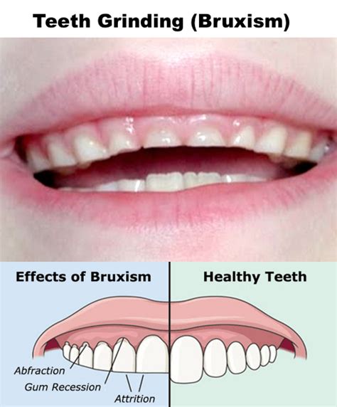 Teeth Grinding (Bruxism) - Lonestar Smiles for Kids