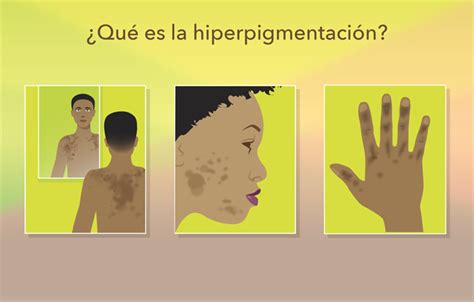 Lo que debe saber sobre la hiperpigmentación