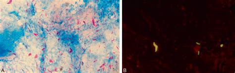 Mycobacterium Tuberculosis AEMiP