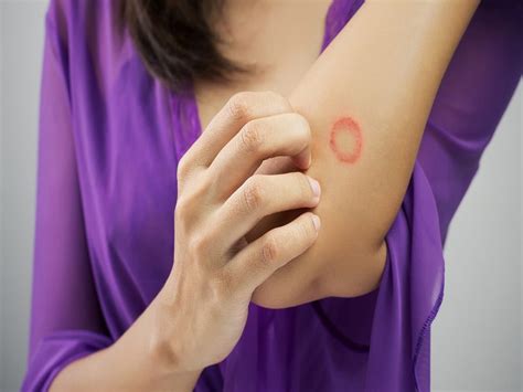 Natural Remedies For Ringworm