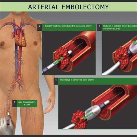 EMBOLECTOMY - Dr. Rakesh Jain