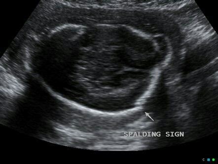 Spalding sign | Sonography, Spalding, Ultrasound