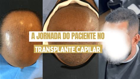 A Jornada Do Paciente No Transplante Capilar Da Consulta Ao