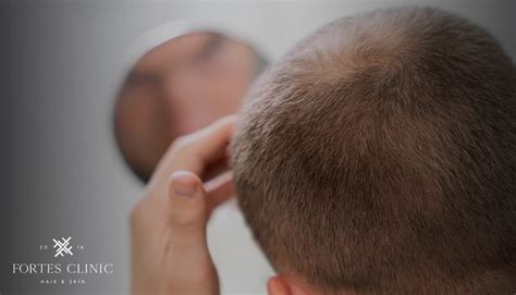 Understanding Traction Alopecia - Fortes Clinic