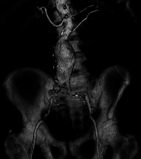 Awake Percutaneous Repair Of A Ruptured Abdominal Aortic Aneurysm Ochsner Journal