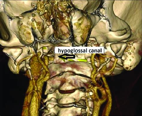 D Volume Rendering Image From Slice Mdct Shows The Pha Crossing