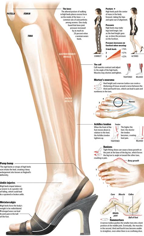 The Downside Of Wearing High Heels Pro Care Physiotherapy And Athletes