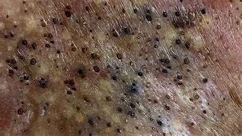 Squeezing Blackheads And Pimples Compilation Of Relaxing Videos From