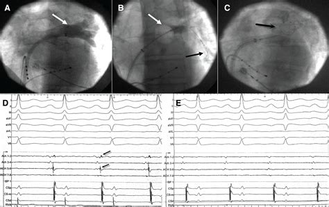 Cryoballoon Ablation Of Atrial Fibrillation A Practical And Effective Approach Georgiopoulos