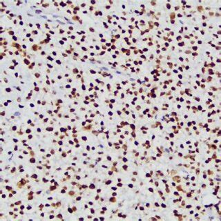 Immunohistochemical Staining Of Tumor Cells Showing Diffuse Positive