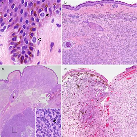 A Normal Skin With Melanocytes Clear Cells Arrowheads And