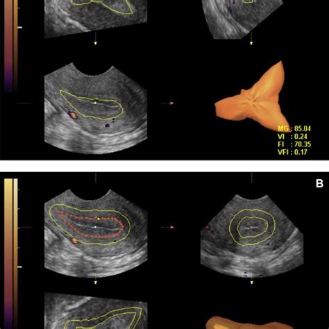 Three Dimensional Power Doppler Images By Virtual Organ Computer Aided