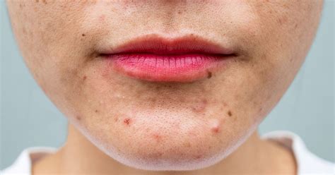 Acne Treatment Types Causes Prevention And More