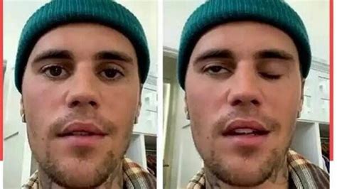 Mengenal Gejala Ramsay Hunt Syndrome Yang Pernah Dialami Justin Bieber