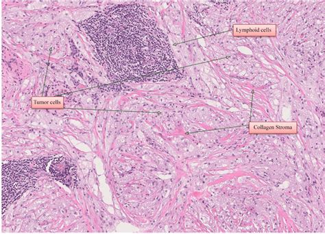 Histological Image Of The Excisional Biopsy H E Magnification