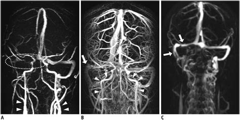 Subtraction MR Venography Acquired From Time Resolved Contrast Enhanced