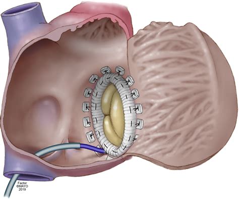 Catheter Ablation Of Supraventricular Tachycardia After Tricuspid Valve