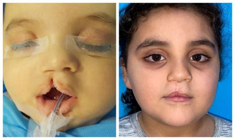 Three Months Old Baby With Right Sided Incomplete Cleft Lip Did Not