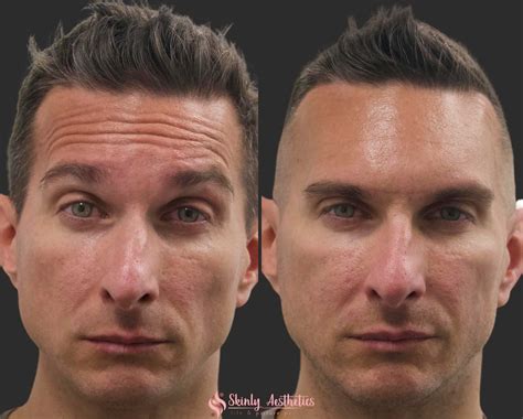 Botox Men Forehead