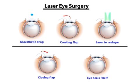 Lasik Refractive Laser Correction Melbourne Australia City Eye Surgeons