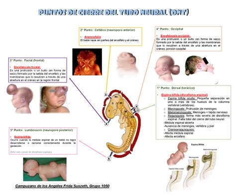 Puntos de cierre del tubo neural y patologías Puntos de cierre del