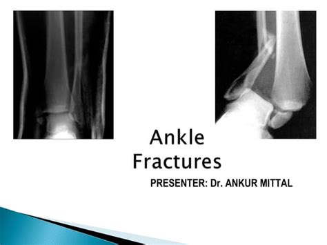 Ankle Fractures Final Ppt