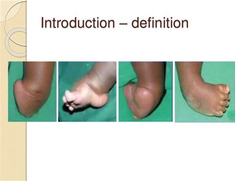 Congenital Clubfoot