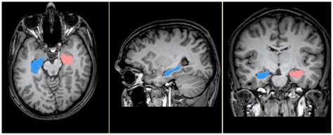 Cerebral Mri Depicting Manual Segmentation Of Hippocampus Figure Shows