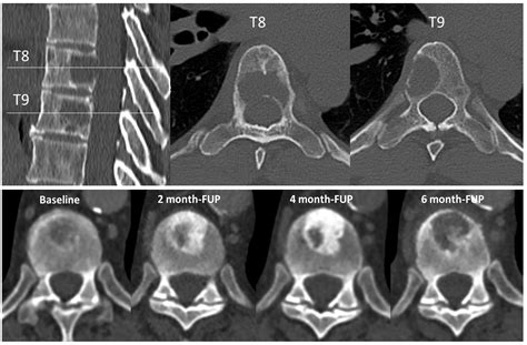 Cancers Free Full Text Fracture Risk Evaluation Of Bone Metastases